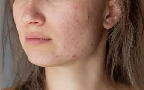 Primo piano del viso di una giovane donna con pelle arrossata e imperfezioni, tipiche dell'acne aestivalis.