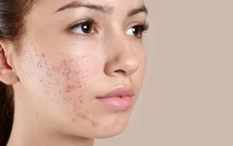 Primo piano del viso di una giovane donna con evidenti bollicine sul viso, segno di acne.