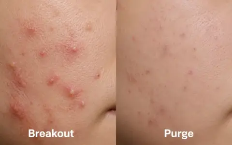 Confronto tra pelle con breakout e papule acne e pelle in fase di "purge", con miglioramento visibile.