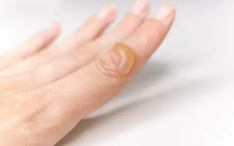 Dito, una bolla da scottatura su un dito, segno di un contatto accidentale con calore.