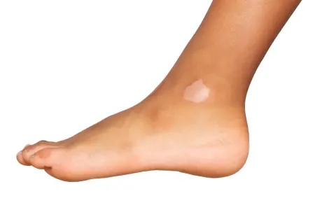 Piede con macchie bianche sulla pelle, segno di mancanza di melanina dopo l'esposizione al sole.