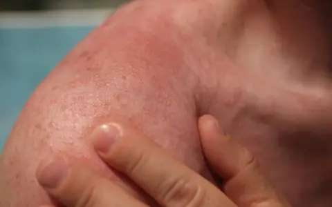 Spalla arrossata e irritata, con piccoli puntini rossi. Potrebbe essere necessario cercare rimedi eritema solare.
