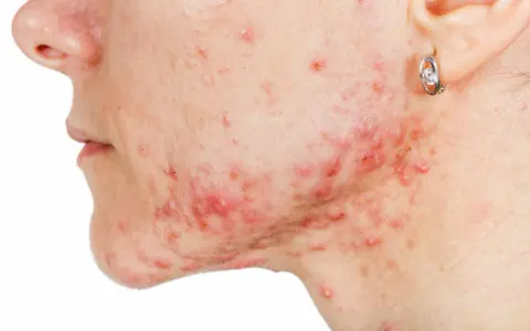 Primo piano del viso di una persona con acne, con un brufolo che non va via e arrossamenti evidenti.
