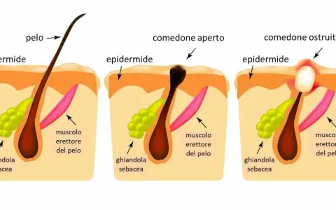 Illustrazione che spiega perchè escono i brufoli: un poro ostruito da sebo e cellule morte causa infiammazione.