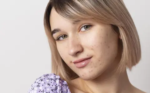 Primo piano di una giovane donna con pelle chiara e capelli biondi, che mostra segni di acne da sudore sul viso.