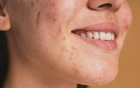 Primo piano del viso di una persona con vari tipi di brufoli e imperfezioni sulla pelle.