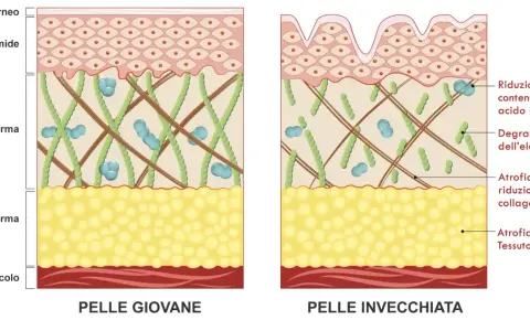 Confronto tra pelle giovane e pelle invecchiata: l'invecchiamento della pelle mostra riduzione di acido ialuronico, collagene, elastina e tessuto adiposo.