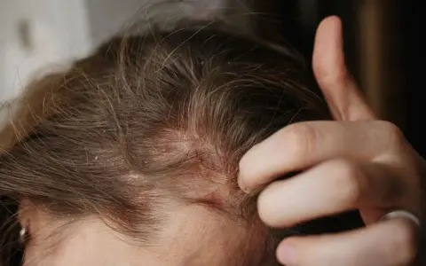 Dita che grattano un cuoio capelluto arrossato e dolorante, con evidenti squame bianche tra i capelli castani.