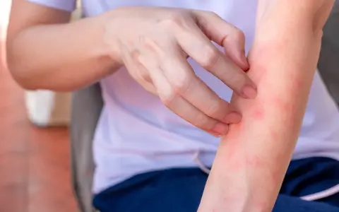 Mano che si gratta un braccio arrossato, con piccoli sfoghi che ricordano l'eczema sulle gambe.
