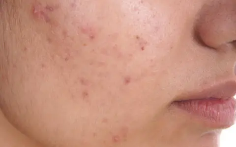 Primo piano di una guancia con diversi brufoli e pori dilatati, che evidenziano la texture della pelle.