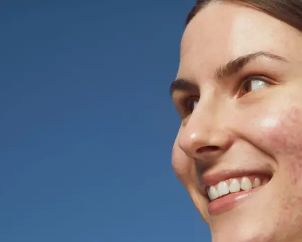 Primo piano di una giovane donna sorridente con pelle imperfetta, dove spicca un brufolo rosso.