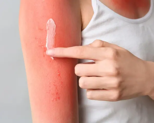 Mano applica crema su braccio arrossato dal sole, cercando rimedi per il prurito dopo abbronzatura.