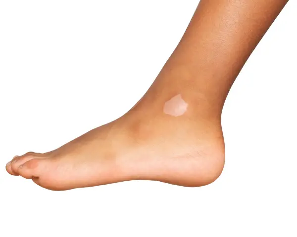 Piede con macchia chiara sulla caviglia, un esempio di puntini bianchi sulle gambe.