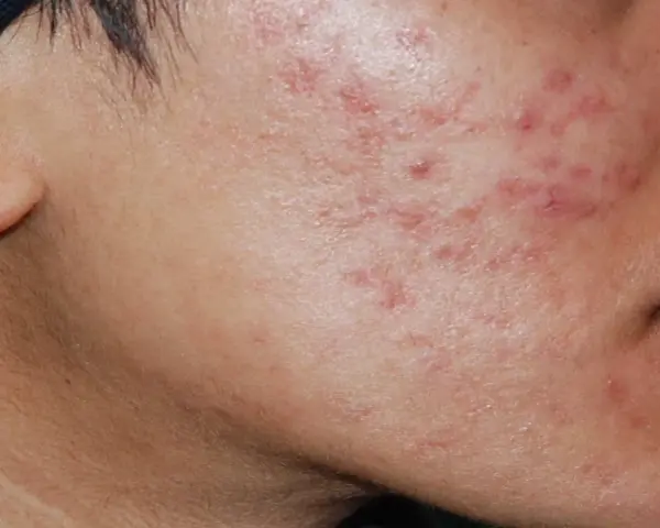 Primo piano del viso di un uomo con evidenti segni di acne ormonale maschile, arrossamenti e pustole sulla guancia e sul mento.
