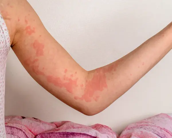 Braccia con eruzioni cutanee rosse e gonfie, segno di un forte prurito nervoso.