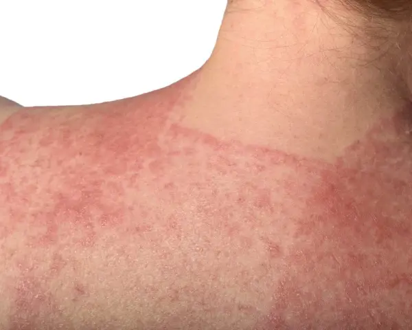 Estesa infiammazione della pelle con arrossamento e piccole pustole sul collo e sulla spalla.