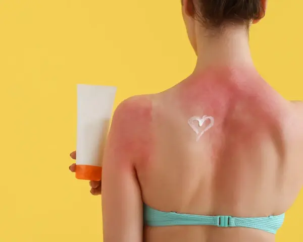 Schiena arrossata e dolente per una scottatura solare. Una crema solare a forma di cuore promette sollievo.