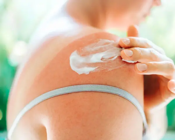 Spalla arrossata dal sole, una mano applica crema solare come crema idratante per lenire la pelle.