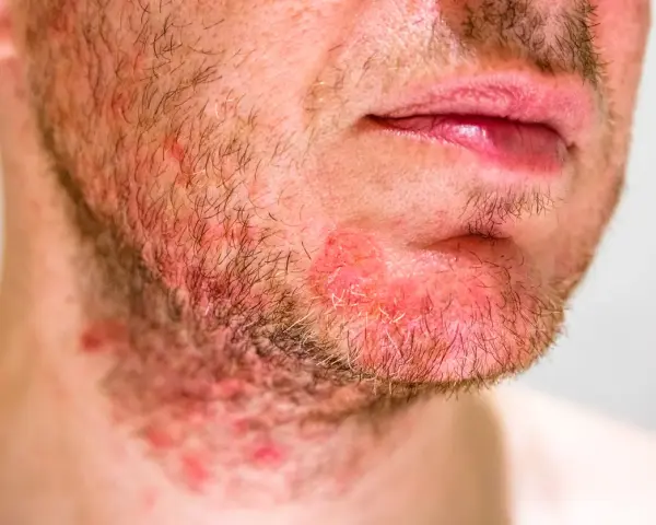 Primo piano di un uomo con dermatite viso, arrossamento e irritazione sulla barba e sul collo.