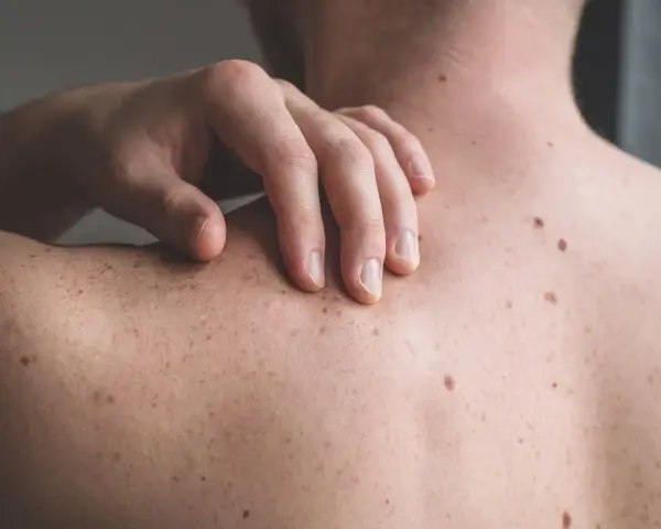 Mano che si gratta la schiena, coperta di nei. Un piccolo brufolo spunta su uno dei nei, un dettaglio inaspettato sulla pelle.