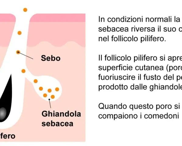 Illustrazione anatomica della pelle che spiega cosa sono i punti neri: il sebo ostruisce il follicolo pilifero.
