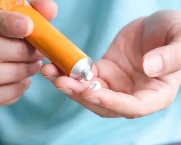 Mano che applica crema al cortisone su un dito, per alleviare la dermatite atopica.
