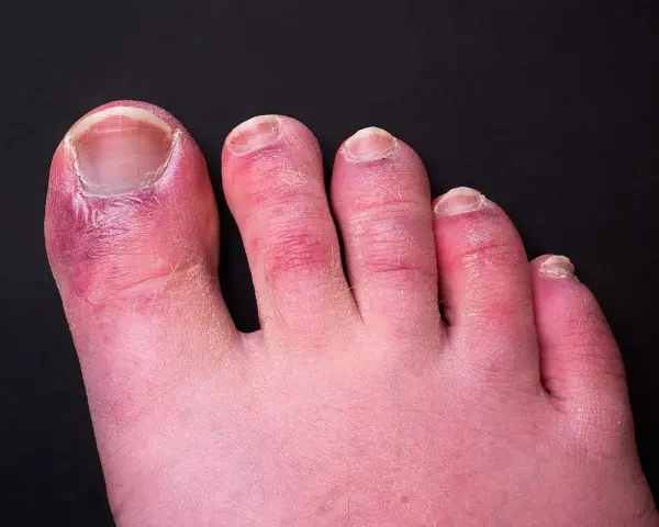 Dita dei piedi arrossate e gonfie, con segni di **geloni ai piedi**. La pelle appare secca e screpolata, soprattutto attorno alle unghie.