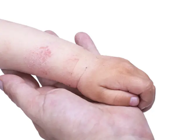 Braccio di bambino con chiazze rosse e squamose, sintomo di dermatite acuta, tenuto da una mano adulta.