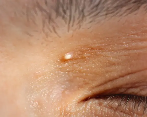 Un piccolo brufolo, simile a grani di miglio, appare sulla pelle rugosa vicino all'occhio.