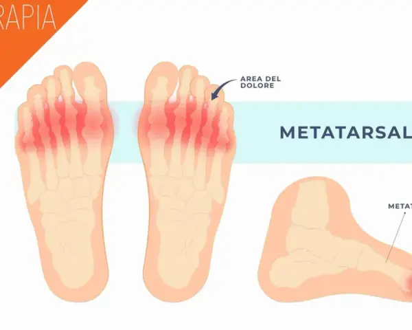 Illustrazione anatomica del piede che mostra la metatarsalgia, un dolore sotto le dita. Rimedi naturali per il dolore sotto le dita del piede.