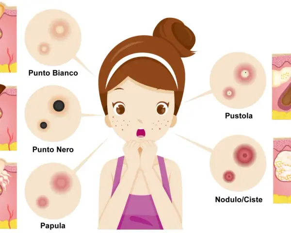Illustrazione di diversi tipi di imperfezioni cutanee, tra cui un brufolo nero, un punto bianco, una papula, una pustola e un nodulo/cisti.