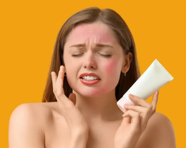 Donna con viso arrossato per eritema solare, che tiene in mano una crema. Potrebbero comparire brufoli a causa dell'irritazione.