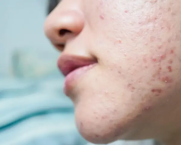 Primo piano del viso di una persona con brufoli pre ciclo, rossori e imperfezioni sulla guancia e sul mento.