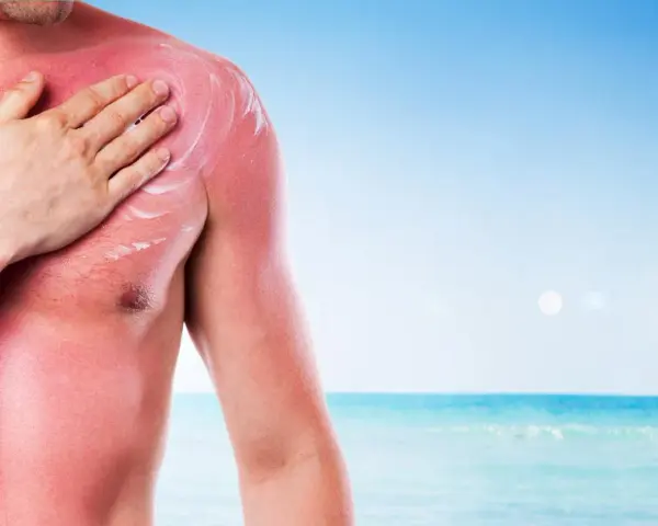 Uomo con forte eritema solare sul petto e spalla, mentre si applica una crema lenitiva. Il mare sullo sfondo ricorda l'estate.