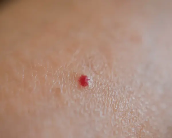 Piccola macchia rossa sulla pelle, tipo bruciatura, che prude.