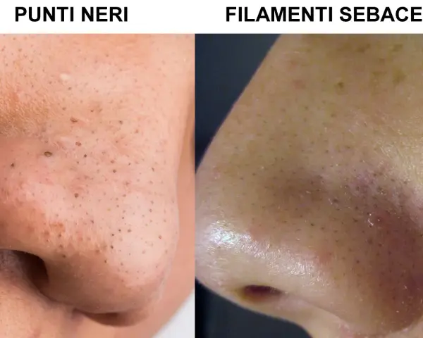 Confronto tra punti neri e filamenti sebacei sul naso. I filamenti sebacei appaiono come piccoli puntini chiari, mentre i punti neri sono più scuri e visibili.