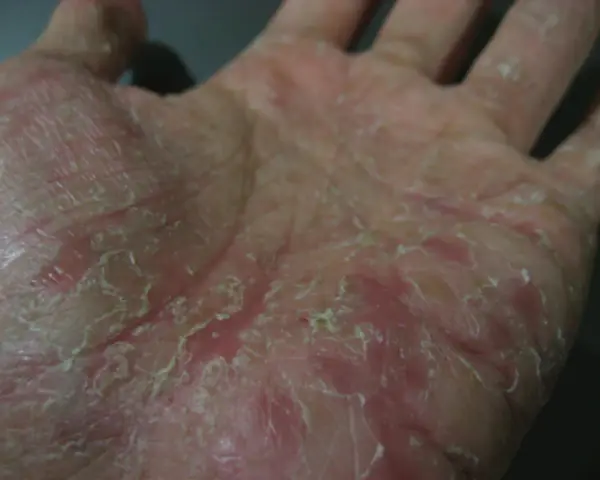 Mano con pelle secca, screpolata e arrossata, sintomo di disidrosi mani.