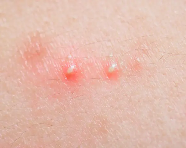 Due pustole sul corpo, rosse e gonfie, con la punta bianca, circondate da peluria sottile.
