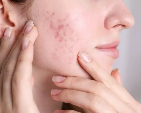 Primo piano del viso di una donna con brufoli sul viso, che si tocca la guancia. Capire perchè vengono i brufoli è il primo passo per una pelle sana.