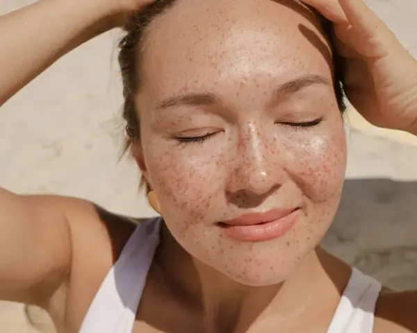 Donna con lentiggini al sole, con le mani tra i capelli. Forse la crema solare tutti i giorni fa male?