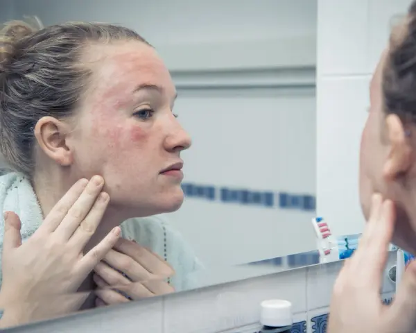 Donna con viso arrossato e irritato si guarda allo specchio, preoccupata che la glicerina viso fa male.