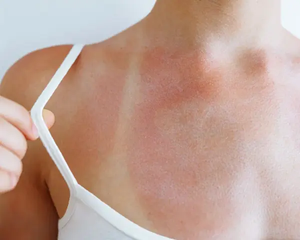 Spalla arrossata e irritata, con segni evidenti di eritema solare prurito. La pelle è segnata dal sole.