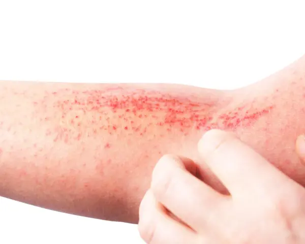 Braccio con eruzione cutanea rossa e puntini, possibile micosi dermatite da stress senza prurito.
