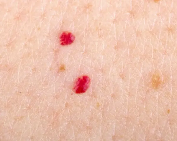 Primo piano della pelle con due angiomi rubino. Si cercano angioma rubino rimedi naturali per attenuare queste piccole macchie rosse.