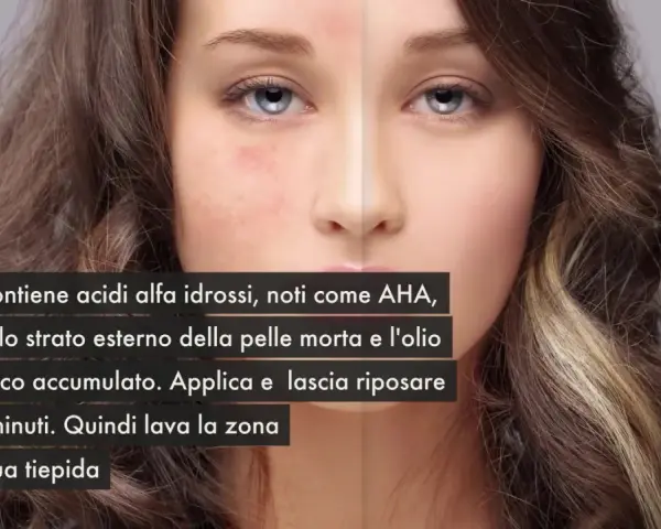 Scopri come togliere i brufoli dal viso con il latte, ricco di AHA che esfoliano e puliscono la pelle.
