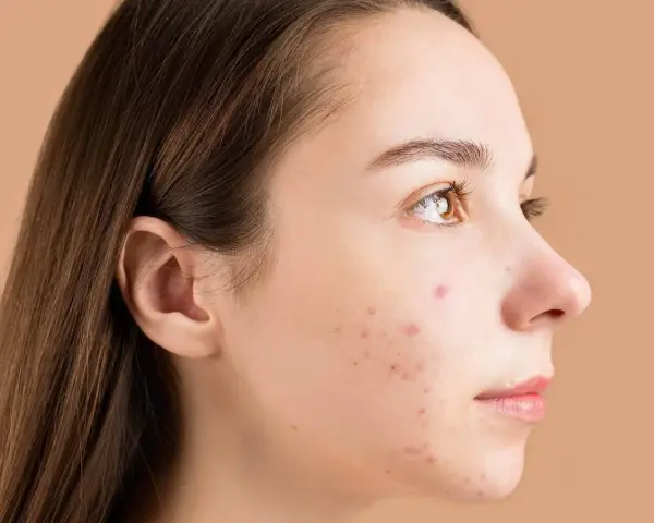 Primo piano del viso di una giovane donna con brufoli. La domanda "quanto ci mette un brufolo ad andare via" è centrale per chi soffre di acne.