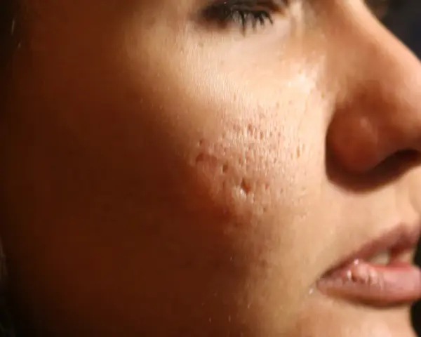 Primo piano del viso di una persona con evidenti cicatrici da acne, simili a macchie varicella, sulla guancia.