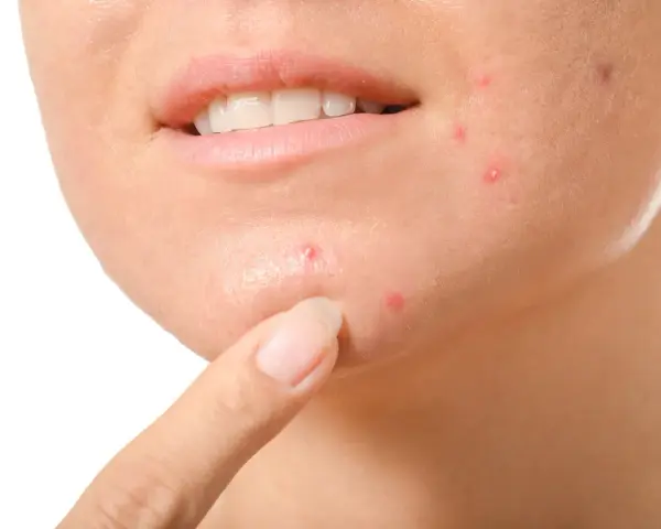 Dito, come non schiacciare i brufoli: un dito indica un brufolo sul viso, vicino alla bocca.