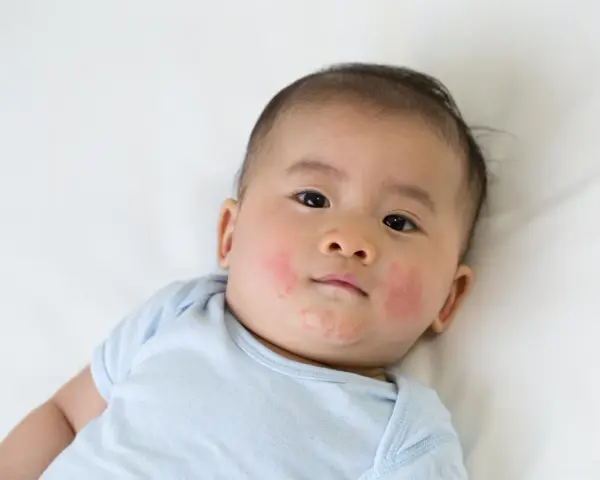 Bambino con guance arrossate e screpolate, forse per la differenza tra dermatite atopica e seborroica.