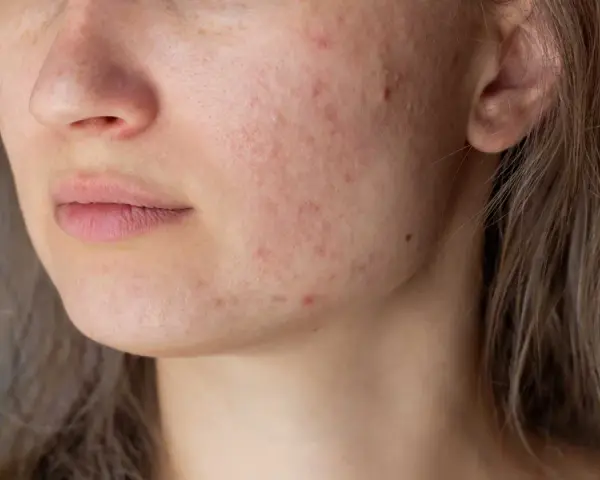 Primo piano del viso di una giovane donna con pelle arrossata e imperfezioni, tipiche dell'acne aestivalis.